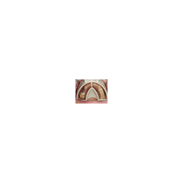 Miratray Implant