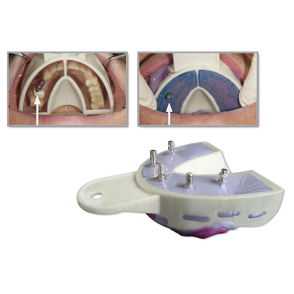 Miratray Implant