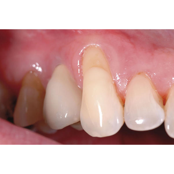 Amaris® Gingiva - Einzelpackung